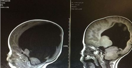 Rođen je bez mozga… Ali 3 godine kasnije, doktori su ostali u šoku vidjevši njegov CT snimak