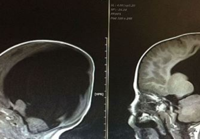 Rođen je bez mozga… Ali 3 godine kasnije, doktori su ostali u šoku vidjevši njegov CT snimak