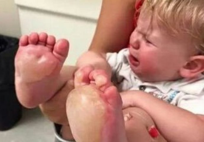 SLUČAJ PREDAT POLICIJI: Dadilja ispekla dijete vrućim tiganjem po stopalima!