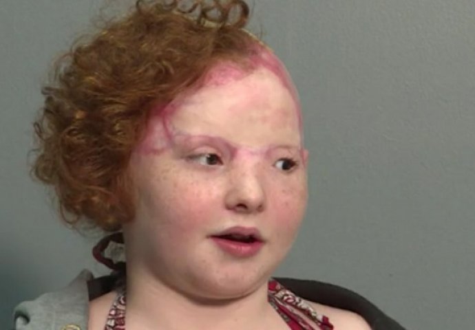 Djevojčica kojoj je vrtuljak oderao kožu do lubanje, ne predaje se! Dosad je imala čak 6 operacija i 28 transfuzija krvi