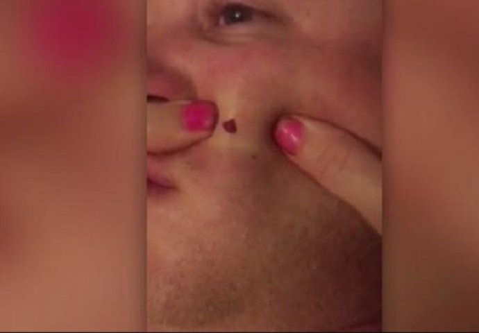 Žena je krenula da mu istiska bubuljicu koja mu je 4 godine bila na obrazu, uslijedila je eksplozija užasa (VIDEO)