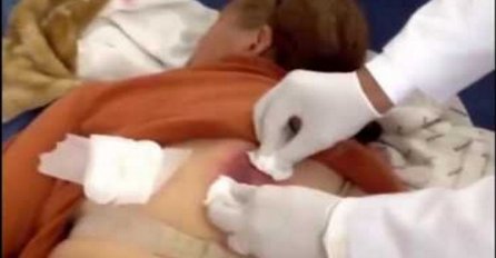 Inficirana gromada od bubuljice joj je zahvatila polovinu leđa, ono što je izašlo iz nje je užasno (VIDEO)