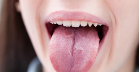 Ako je vaš jezik ovakav - posjetite doktora