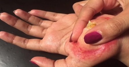 Iscjedila je ogroman žulj sa dlana, ali dobro obratite pažnju na sami kraj ovog snimka (VIDEO)