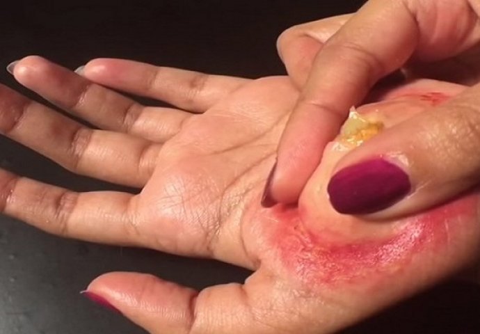 Iscjedila je ogroman žulj sa dlana, ali dobro obratite pažnju na sami kraj ovog snimka (VIDEO)
