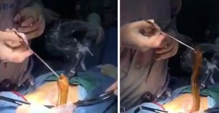 Zbog seksualnog nagona, završio na operacionom stolu: Pogledajte šta su iz njega izvadili (VIDEO)