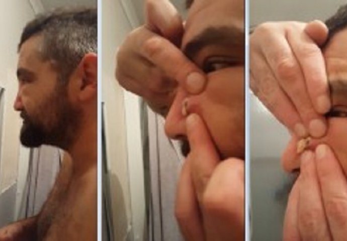 Odlučio je da istisne ogromnu bubuljicu na nosu: Stisnuo je jako, a pozlit će vam od onog što je otišlo u lavabo (VIDEO)