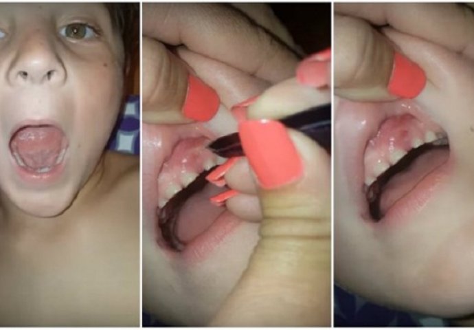 Odvratan video pokazuje na šta liče usta djeteta koje grize nokte