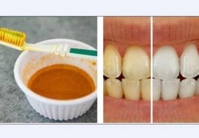 Čarobni trik za izbjeljivanje zuba u kućnim uslovima.