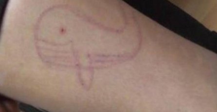 POLUDJELI ZA IGRICOM: Djevojčica se sjekla po ruci zbog "plavog kita"