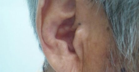 Nova studija pokazala: Ukoliko imate ovo na uhu, prijeti vam opasan rizik od moždanog udara