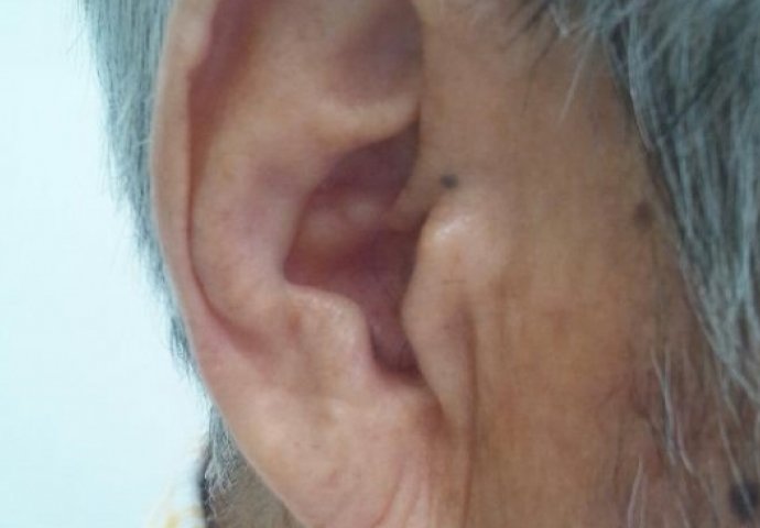 Nova studija pokazala: Ukoliko imate ovo na uhu, prijeti vam opasan rizik od moždanog udara