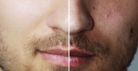 RICINUSOVO ULJE ZA KOŽU: Evo kako pomaže u teškoj borbi protiv bora, akni i ožiljaka