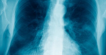 GODINAMA JE IMAO PROBLEMA SA PLUĆIMA,  ali nije ni slutio da je dvije decenije nosio nešto JEZIVO u svom tijelu!