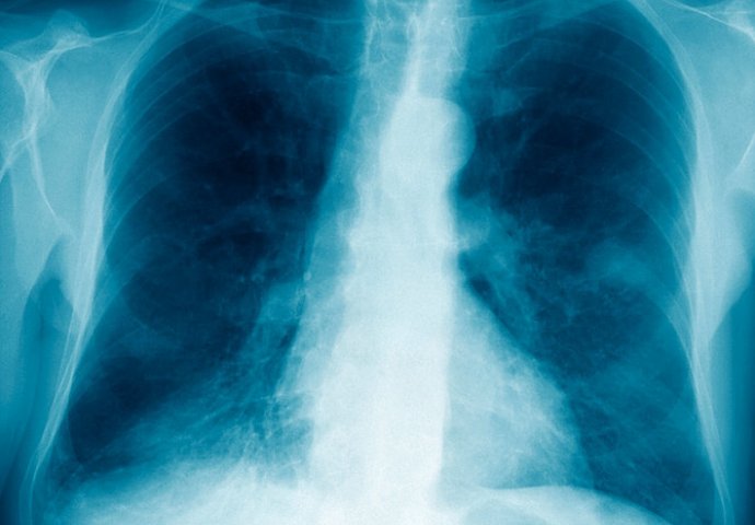 GODINAMA JE IMAO PROBLEMA SA PLUĆIMA,  ali nije ni slutio da je dvije decenije nosio nešto JEZIVO u svom tijelu!