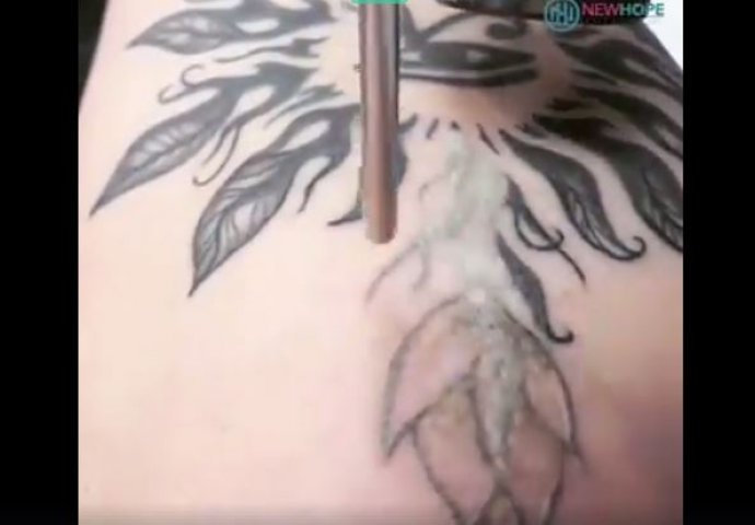 Mislili ste da su tetovaže trajne - VARATE SE: Ovim laserom tetovaža se skida za nekoliko sekundi (VIDEO)