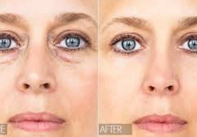 Trik koji briše tamne podočnjake za samo 30 sekundi  