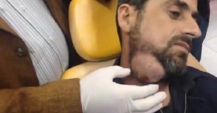 Čovjek je dugo godina trpio ovaj užas na licu, a onda je odlučio da ga ukloni(VIDEO)