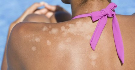Gljivično oboljenje kože: Simptomi i LIJEČENJE!