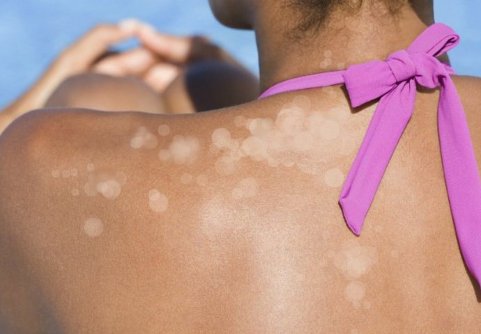 Gljivično oboljenje kože: Simptomi i LIJEČENJE!