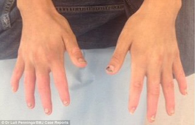 4195196600000578-4622324-although-some-parts-of-his-fingers-had-started-to-die-off-from-t-a-2-1498124307563