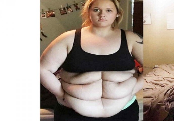 Nakon što je smršala nevjerovatnih 78 kilograma, pojavio se novi problem: Nakon operacije, ona je neprepoznatljiva!