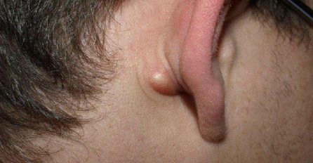 Ako imate KVRŽICU na vratu, leđima ili iza uha? Ovo morate znati