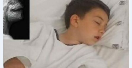 Dječak osjetio veliku bol dok je jeo hamburger, a onda je rendgen pokazao ono čega se majka najviše plašila (VIDEO)