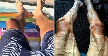 FOTOGRAFIJA KOJA JE ZGROZILE MNOGE: Kako izgledaju noge prije i poslije Tour de Francea  