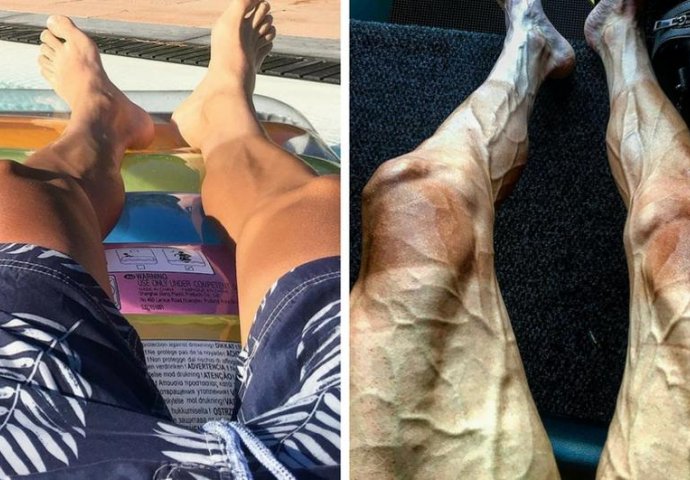 FOTOGRAFIJA KOJA JE ZGROZILE MNOGE: Kako izgledaju noge prije i poslije Tour de Francea  