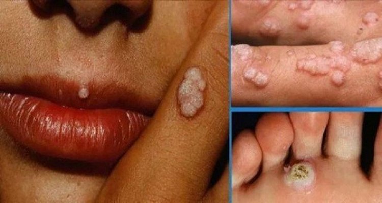 hpv-human-papilloma-virus-learn-how-to-protect-yourself-before-it-s-too-late