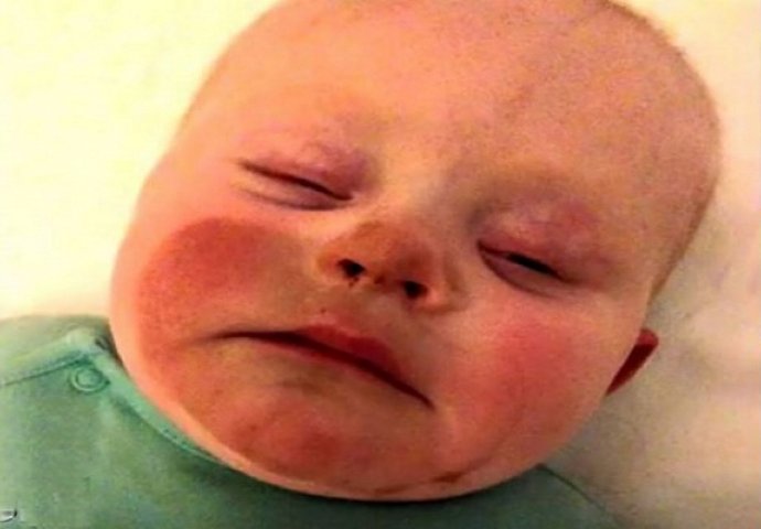 Mame, pripazite što radite: Beba nakon dojenja dobila čudne mrlje na licu