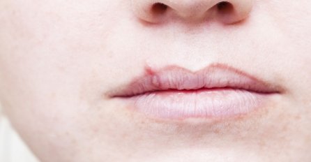 Imate herpes na usnama: Šta se tada događa u vašem organizmu?