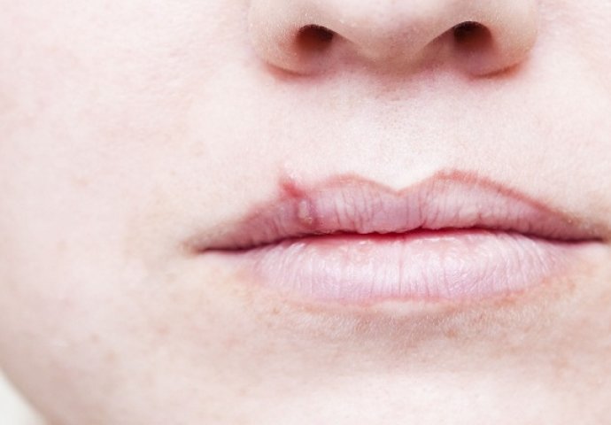 Imate herpes na usnama: Šta se tada događa u vašem organizmu?