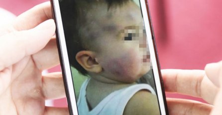 Djevojčica izujedana u vrtiću puštena na kućno liječenje 