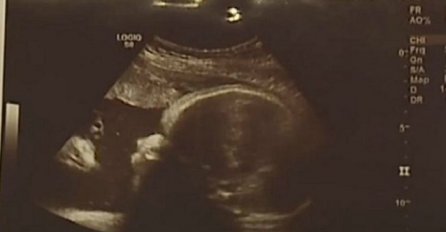 Roditelji su ostali U ČUDU kada su vidjeli ultrazvuk: Uvjereni su da je detalj pored bebine glave ZNAK