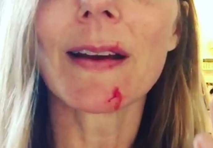 PRESTRAŠILA FANOVE: Slavna pjevačica krvava i izgrebana: "Ne volim je više"
