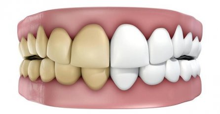 MNOGI ĆE SE RAZOČARATI: Ovo su glavni krivci koji utiču na promjenu boje naših zuba
