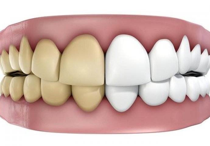 MNOGI ĆE SE RAZOČARATI: Ovo su glavni krivci koji utiču na promjenu boje naših zuba