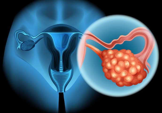 OPREZ: Ovo mnoge žene rade, a ne znaju da povećava rizik od raka jajnika