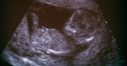 Cijelu trudnoću odbijala je preglede: Na porođaju u bolnici otkriveno je da se OVAKVA BEBA dešava jednom u 625 miliona slučajeva