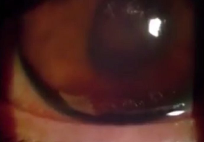 Žalio se na NEPODNOŠLJIVE BOLOVE u oku, a onda su mu ljekari našli UŽASNU STVAR! (VIDEO)