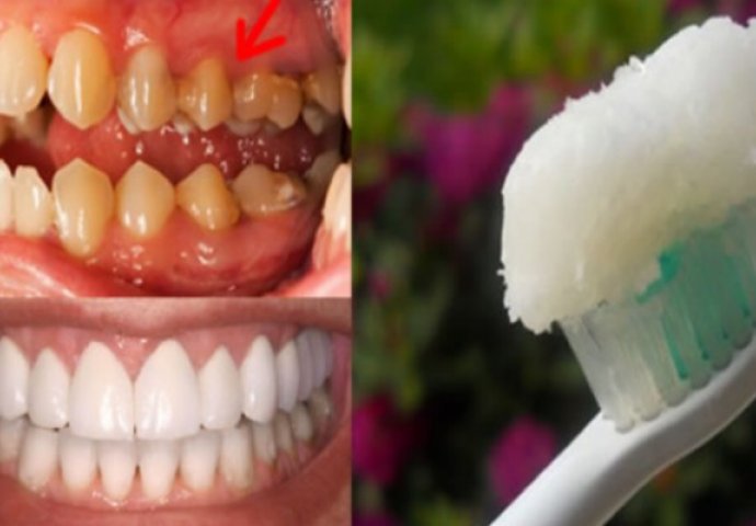 JEDNOSTAVNO, A UČINKOVITO: Ova jedinstvena pasta može ukloniti KAMENAC sa zuba za samo par dana!