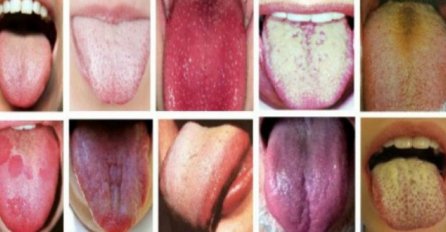 PRVI ZNAK TEŠKOG OBOLJENJA: Ukoliko primijetite OVO na svom jeziku odmah idite doktoru! 