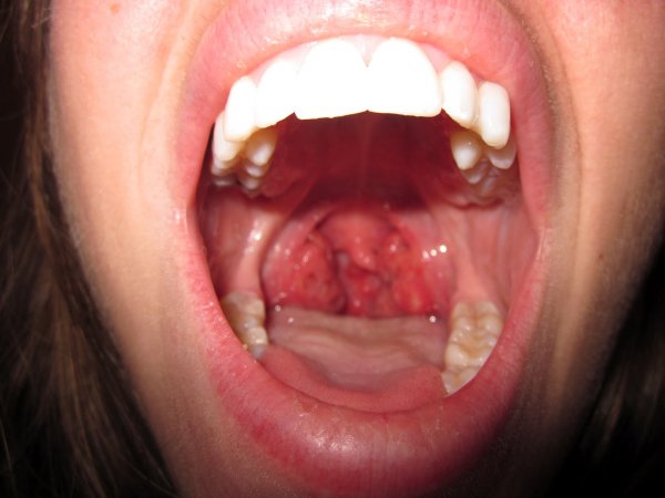 normal-tonsils-vs-abnormal-tonsils