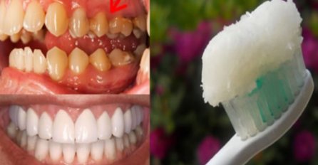 TAKO LAKO: Ova jedinstvena pasta može ukloniti KAMENAC sa zuba za samo NEKOLIKO DANA!