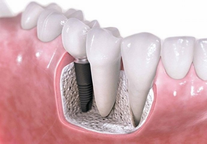 ZUBNI IMPLANTI: Ovo morate da znate!