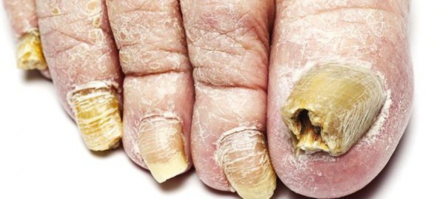 symptoms-of-toenail-fungus-600x270