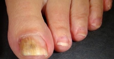 Potpuno prirodno izliječite problem gljivica na stopalima