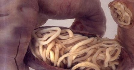 Ako osjećate OVE simptome, vaša crijeva su puna PARAZITA! Srećom možete ih ukloniti brzo s ovom namirnicom…